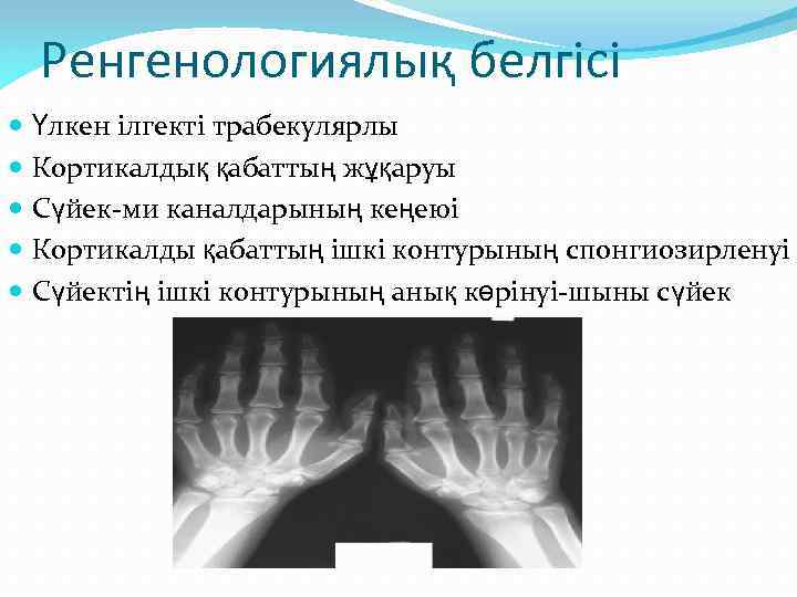Ренгенологиялық белгісі Үлкен ілгекті трабекулярлы Кортикалдық қабаттың жұқаруы Сүйек-ми каналдарының кеңеюі Кортикалды қабаттың ішкі