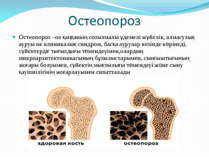 Остеопороз –ол қаңқаның созылмалы үдемелі жүйелік, алмасулық ауруы не клиникалық синдром, басқа аурулар кезінде