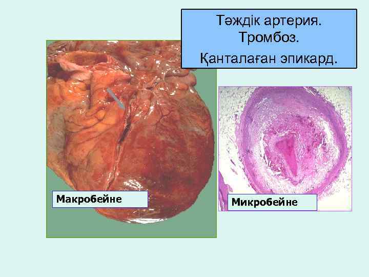 Тәждік артерия. Тромбоз. Қанталаған эпикард. Макробейне Микробейне 