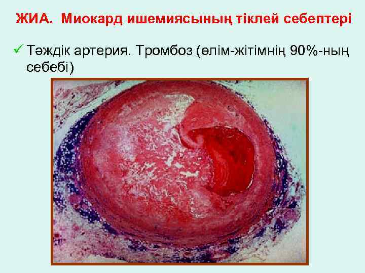 ЖИА. Миокард ишемиясының тіклей себептері ü Тәждік артерия. Тромбоз (өлім-жітімнің 90%-ның себебі) 