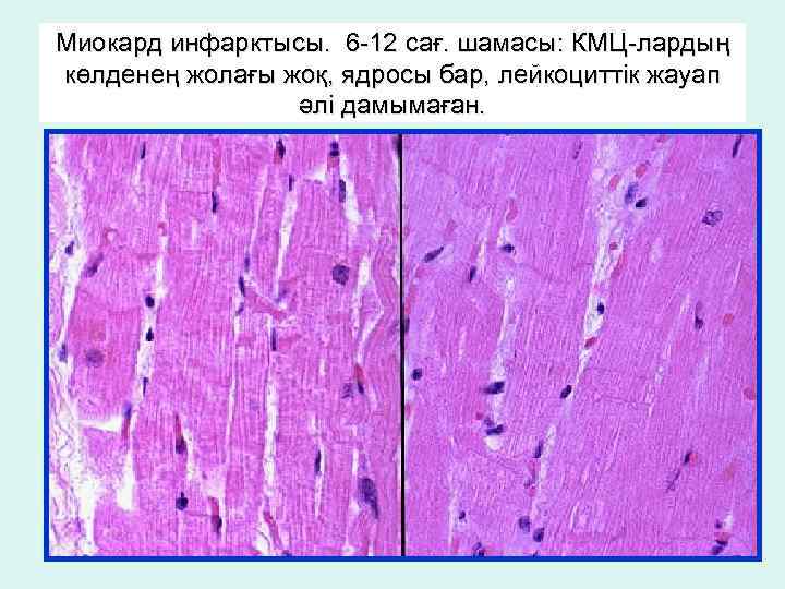 Миокард инфарктысы. 6 -12 сағ. шамасы: КМЦ-лардың көлденең жолағы жоқ, ядросы бар, лейкоциттік жауап