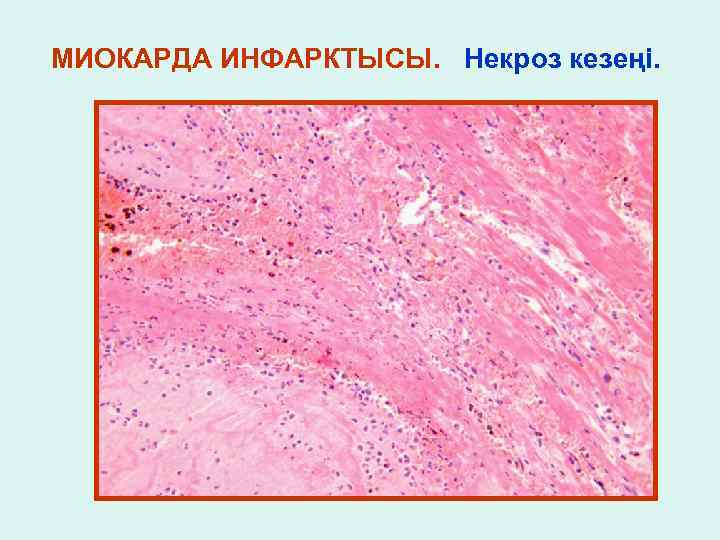 МИОКАРДА ИНФАРКТЫСЫ. Некроз кезеңі. 