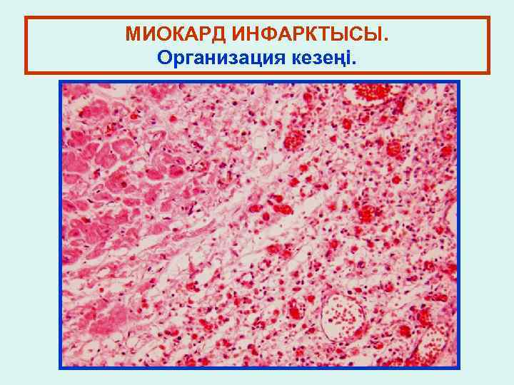 МИОКАРД ИНФАРКТЫСЫ. Организация кезеңі. 