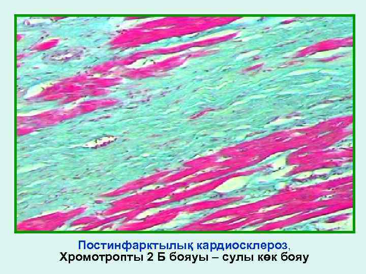 Постинфарктылық кардиосклероз, Хромотропты 2 Б бояуы – сулы көк бояу 