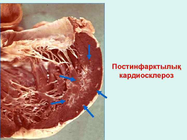 Постинфарктылық кардиосклероз 