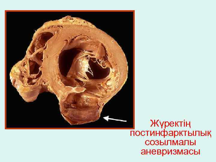 Жүректің постинфарктылық созылмалы аневризмасы 