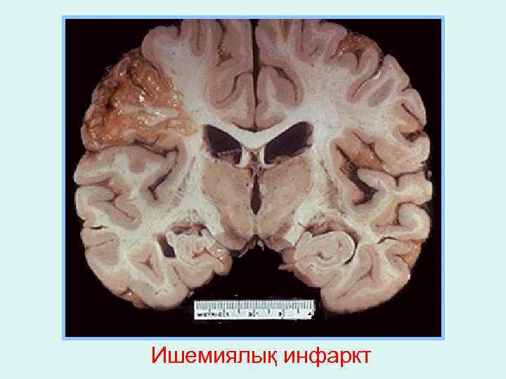 Ишемиялық инфаркт 