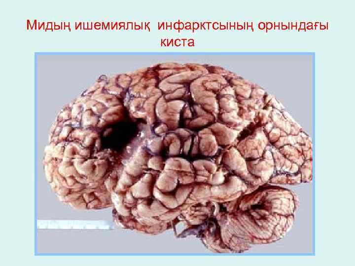 Мидың ишемиялық инфарктсының орнындағы киста 