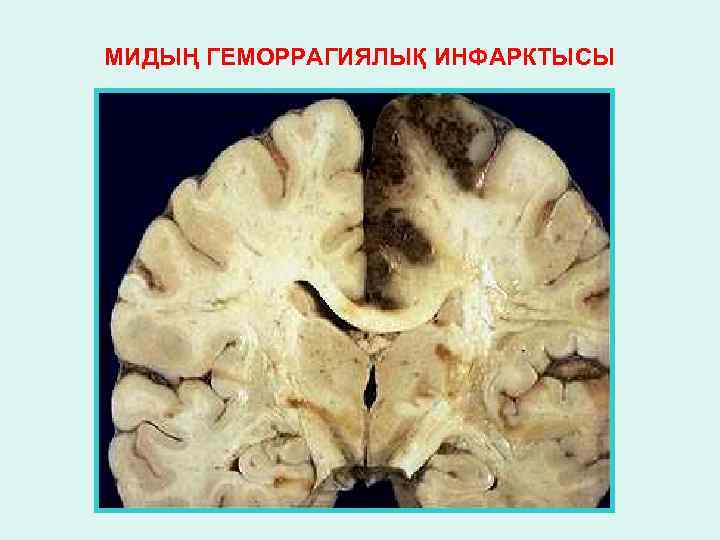 МИДЫҢ ГЕМОРРАГИЯЛЫҚ ИНФАРКТЫСЫ 