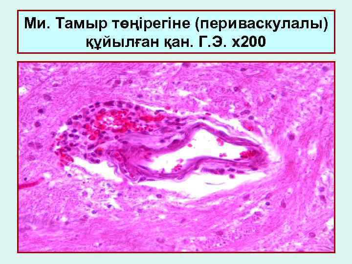 Ми. Тамыр төңірегіне (периваскулалы) құйылған қан. Г. Э. х200 