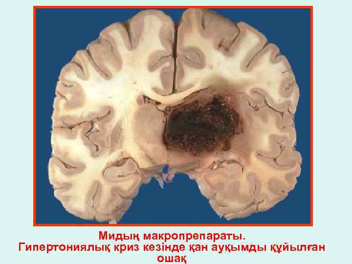 Мидың макропрепараты. Гипертониялық криз кезінде қан ауқымды құйылған ошақ 