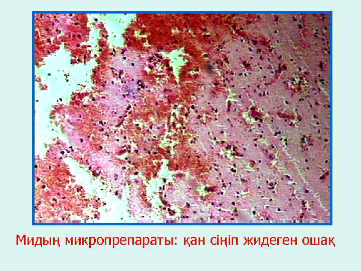 Мидың микропрепараты: қан сіңіп жидеген ошақ 