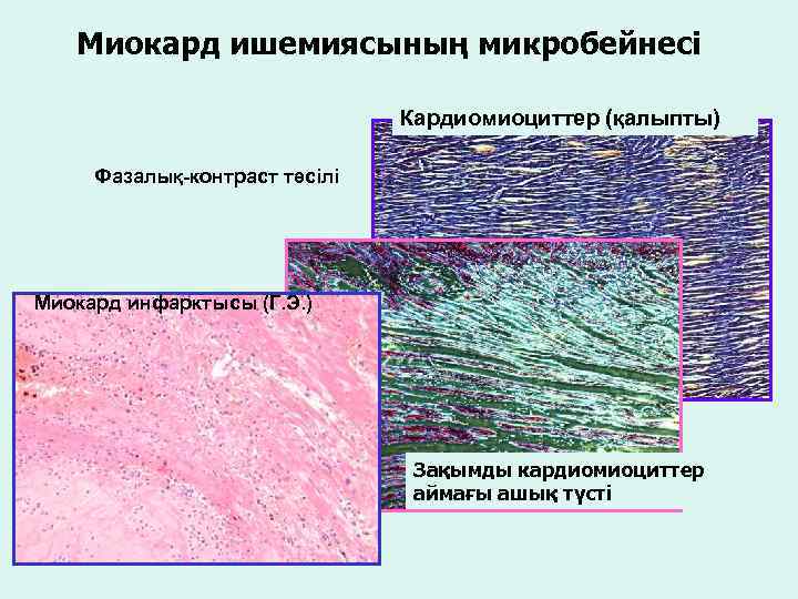 Миокард ишемиясының микробейнесі Кардиомиоциттер (қалыпты) Фазалық-контраст тәсілі Миокард инфарктысы (Г. Э. ) Зақымды кардиомиоциттер