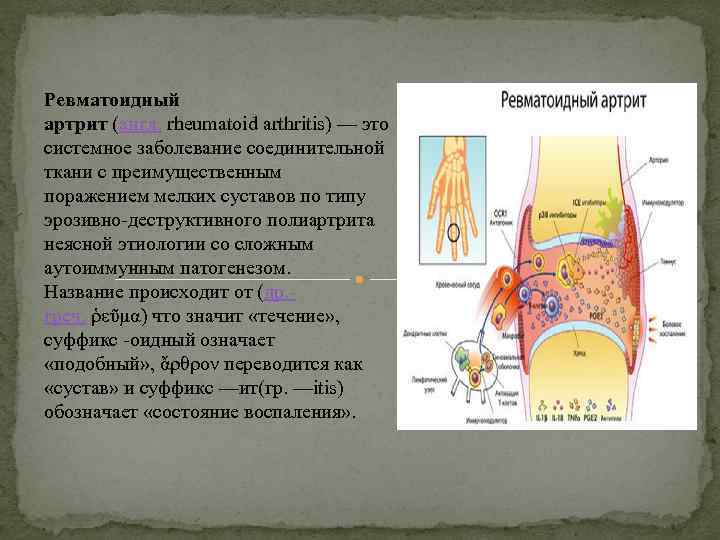 Ревматоидный артрит (англ. rheumatoid arthritis) — это системное заболевание соединительной ткани с преимущественным поражением