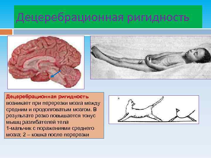 Децеребрационная ригидность возникает при перерезки мозга между средним и продолговатым мозгом. В результате резко