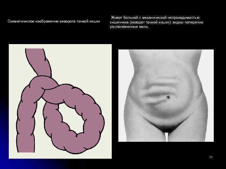 Схематическое изображение заворота тонкой кишки Живот больной с механической непроходимостью кишечника (заворот тонкой кишки):