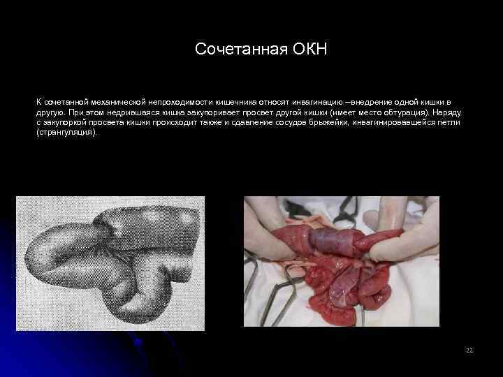 Сочетанная ОКН К сочетанной механической непроходимости кишечника относят инвагинацию внедрение одной кишки в другую.