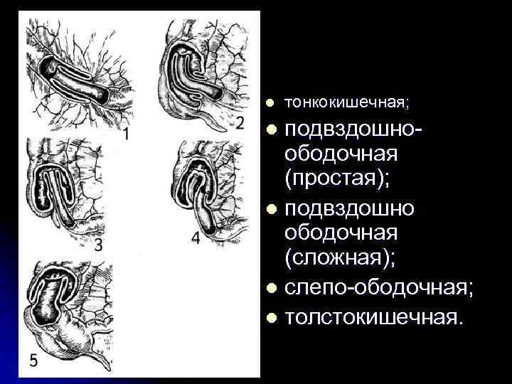 l тонкокишечная; подвздошно ободочная (простая); l подвздошно ободочная (сложная); l слепо ободочная; l толстокишечная.