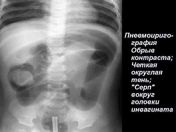 Пневмоиригография Обрыв контраста; Четкая округлая тень; 