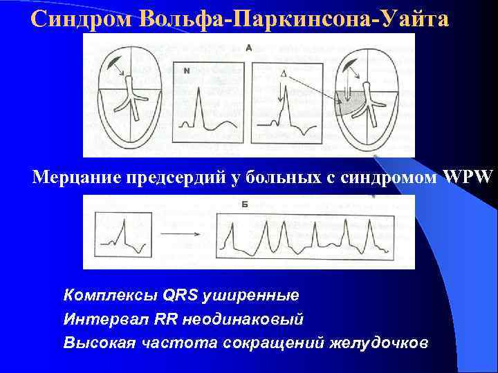 Синдром Вольфа-Паркинсона-Уайта Мерцание предсердий у больных с синдромом WPW Комплексы QRS уширенные Интервал RR