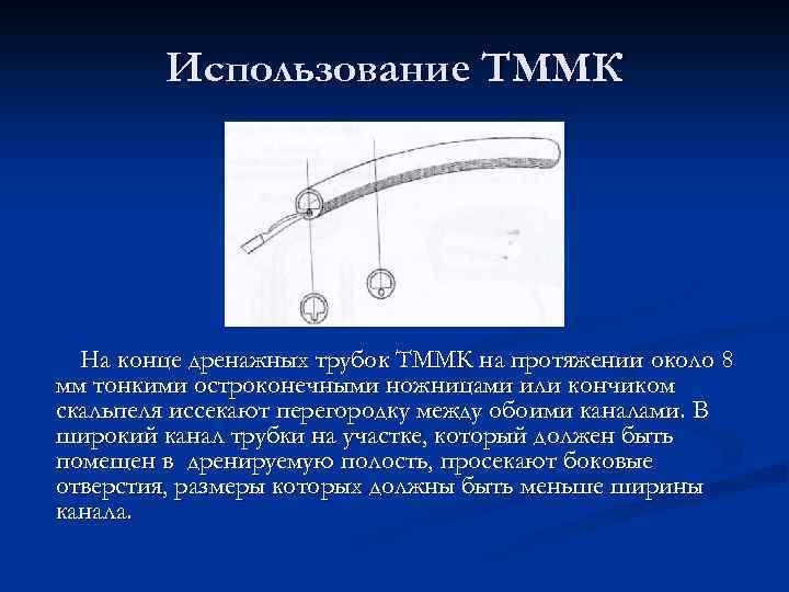 Использование ТММК На конце дренажных трубок ТММК на протяжении около 8 мм тонкими остроконечными