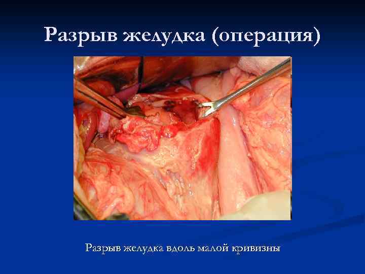 Разрыв желудка (операция) Разрыв желудка вдоль малой кривизны 