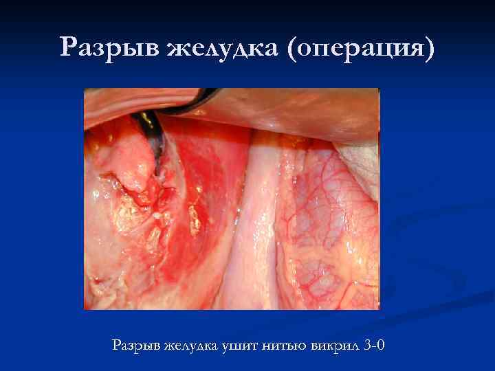 Разрыв желудка (операция) Разрыв желудка ушит нитью викрил 3 -0 
