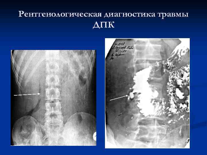 Открытые травмы живота картинки