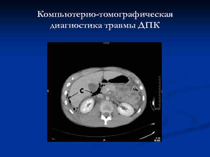 Компьютерно-томографическая диагностика травмы ДПК 