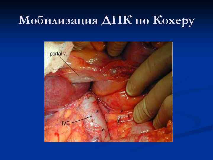 Мобилизация ДПК по Кохеру 