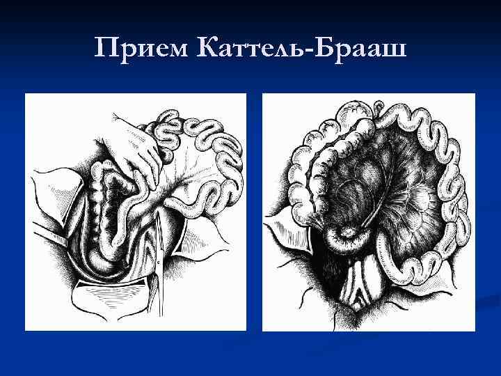 Прием Каттель-Брааш 