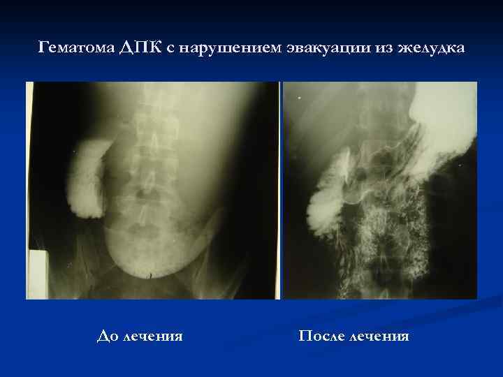 Гематома ДПК с нарушением эвакуации из желудка До лечения После лечения 
