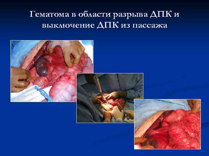 Гематома в области разрыва ДПК и выключение ДПК из пассажа 