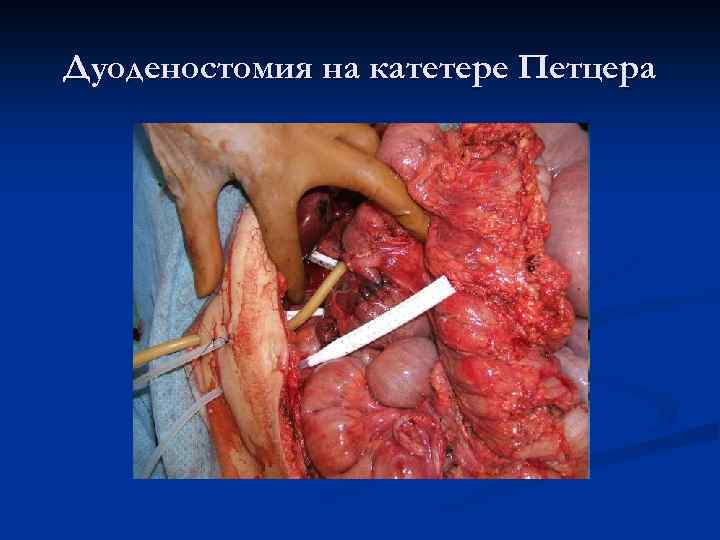Дуоденостомия на катетере Петцера 