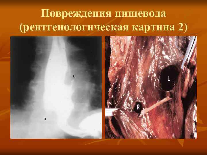 Повреждения пищевода (рентгенологическая картина 2) 