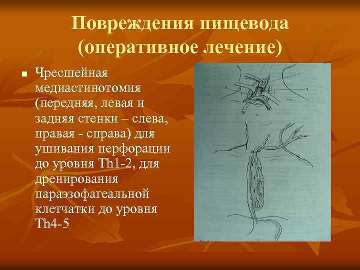 Повреждения пищевода (оперативное лечение) n Чресшейная медиастинотомия (передняя, левая и задняя стенки – слева,