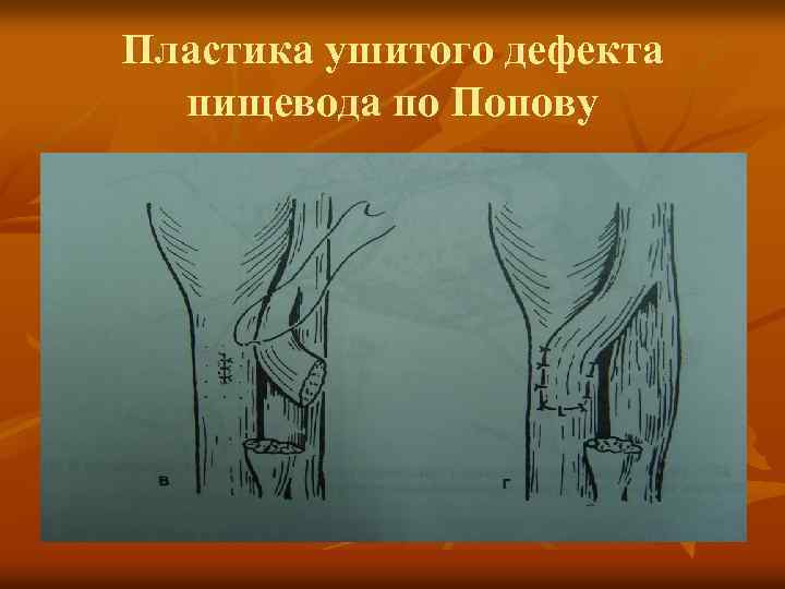 Пластика ушитого дефекта пищевода по Попову 
