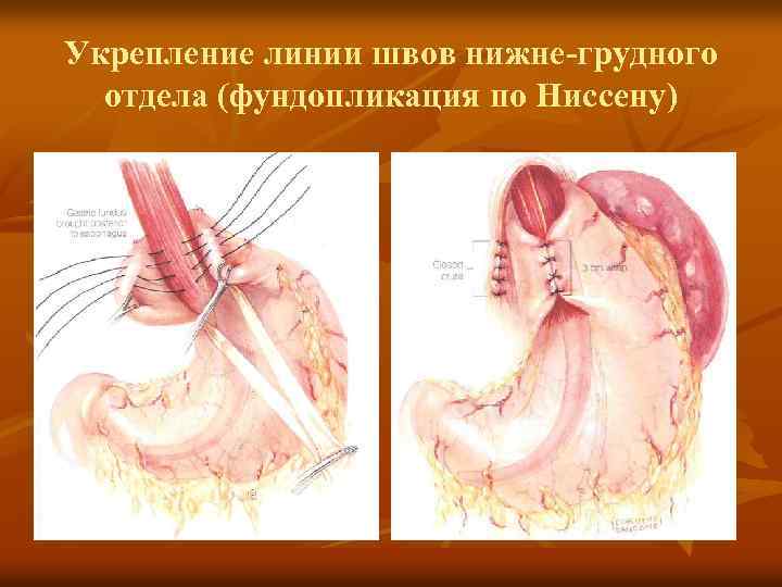 Укрепление линии швов нижне-грудного отдела (фундопликация по Ниссену) 