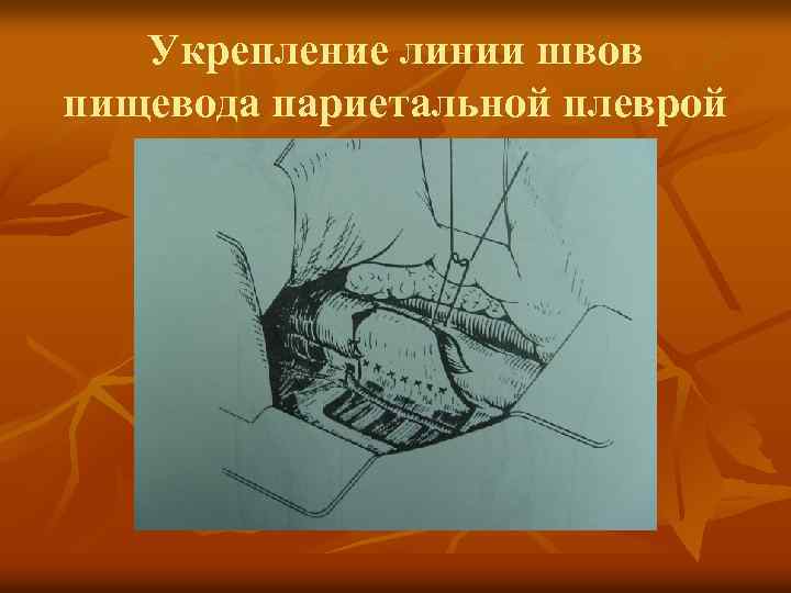 Укрепление линии швов пищевода париетальной плеврой 