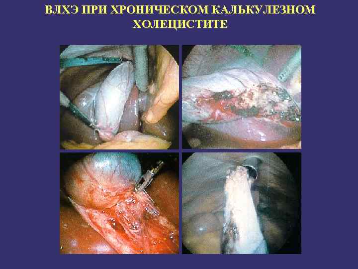 ВЛХЭ ПРИ ХРОНИЧЕСКОМ КАЛЬКУЛЕЗНОМ ХОЛЕЦИСТИТЕ 