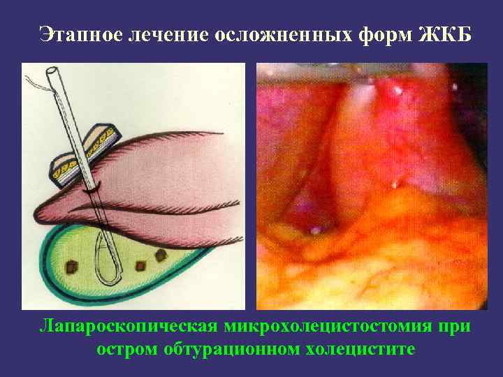 Этапное лечение осложненных форм ЖКБ Лапароскопическая микрохолецистостомия при остром обтурационном холецистите 