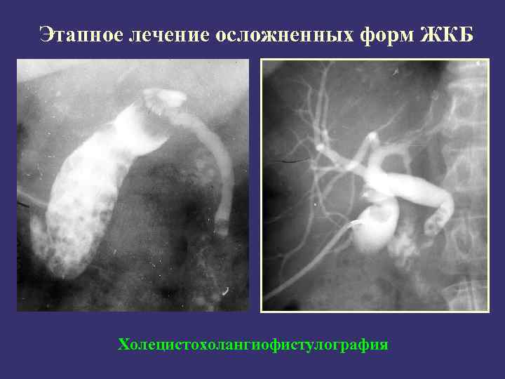 Этапное лечение осложненных форм ЖКБ Холецистохолангиофистулография 