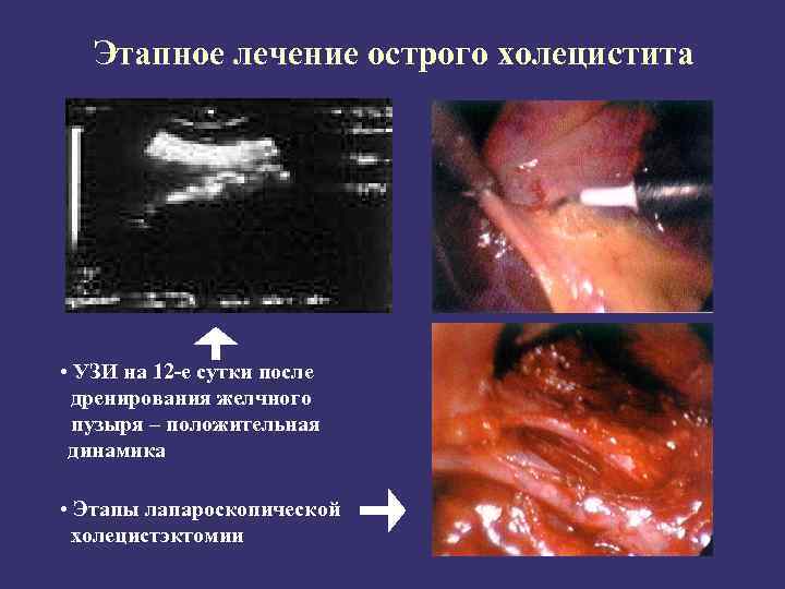 Этапное лечение острого холецистита • УЗИ на 12 -е сутки после дренирования желчного пузыря