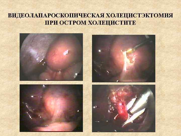ВИДЕОЛАПАРОСКОПИЧЕСКАЯ ХОЛЕЦИСТЭКТОМИЯ ПРИ ОСТРОМ ХОЛЕЦИСТИТЕ 