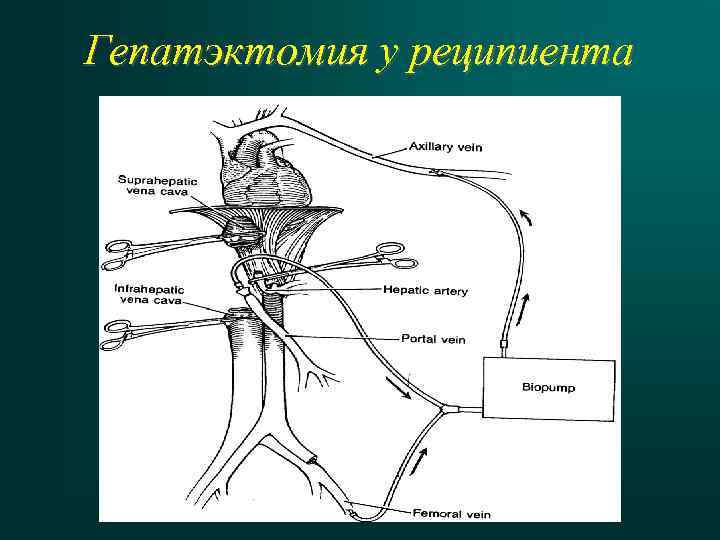 Гепатэктомия у реципиента 