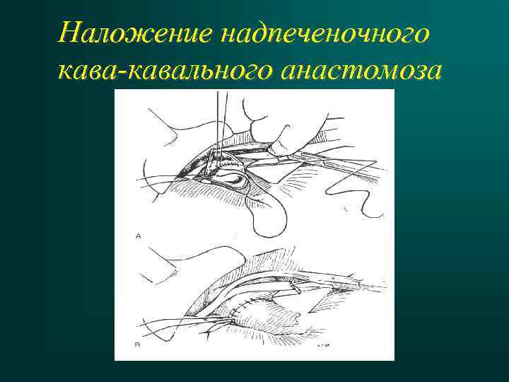 Анастомозы передней брюшной стенки. Кавакавальные анастомозы анатомия. Кава кавальные анастомозы анатомия. Кава-кавальный анастомоз схема. Кава кавальные и портокавальные анастомозы.