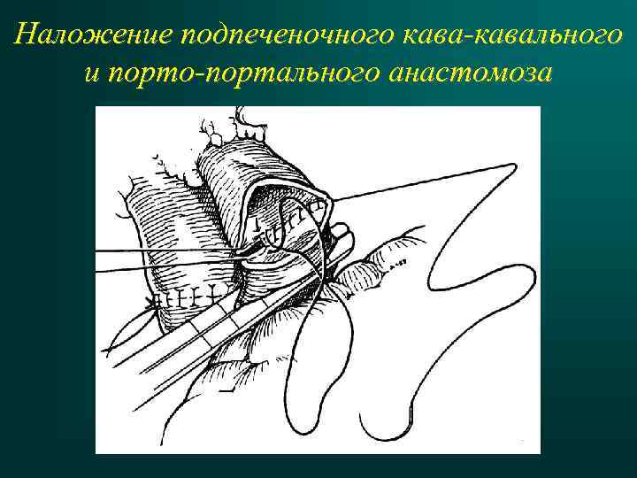 Наложение подпеченочного кава-кавального и порто-портального анастомоза 