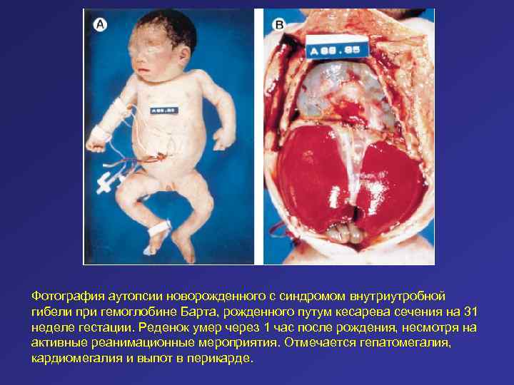 Фотография аутопсии новорожденного с синдромом внутриутробной гибели при гемоглобине Барта, рожденного путум кесарева сечения