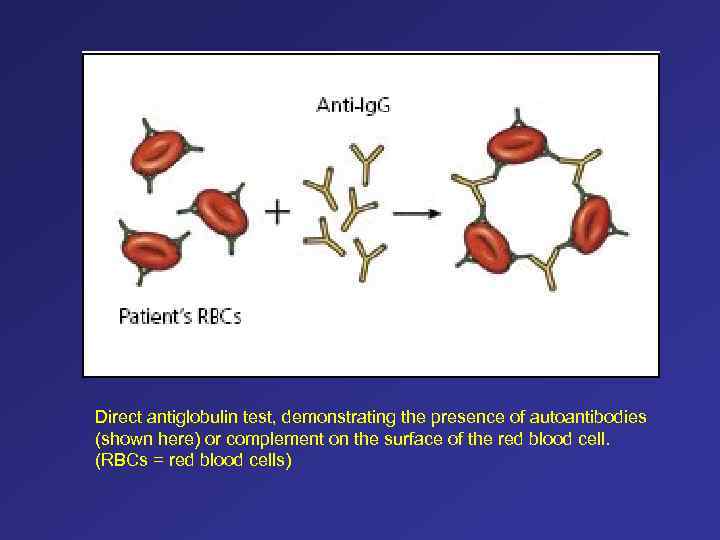 Direct antiglobulin test, demonstrating the presence of autoantibodies (shown here) or complement on the