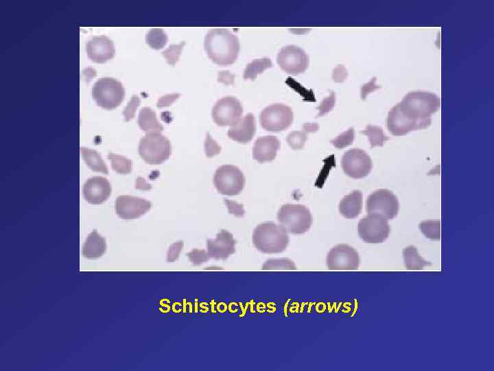 Schistocytes (arrows) 